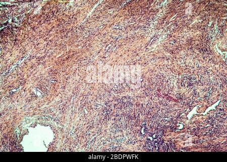 Herzmuskelentzündung erkranktes Gewebe 100x Stockfoto