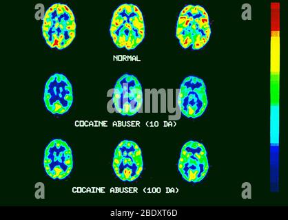 PET-Scans, Normal und Kokain-Missbrauer Stockfoto