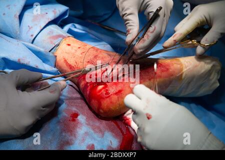 Chirurgen und Techniker führen eine Metallplatte in den Fußbereich des Fußes eines Patienten ein, um einen Knochenbruch und ein beschädigtes Gelenk zu reparieren. Stockfoto