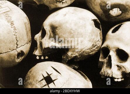 Schädel Zeigen Trepanation Stockfoto