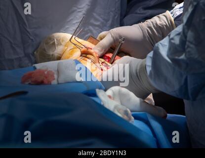 Chirurgen und Techniker führen eine Metallplatte in den Fußbereich des Fußes eines Patienten ein, um einen Knochenbruch und ein beschädigtes Gelenk zu reparieren. Stockfoto