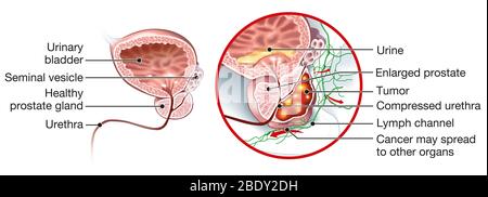 Medizinische Illustration zeigt gesunde Prostata und Prostatakrebs, Stockfoto