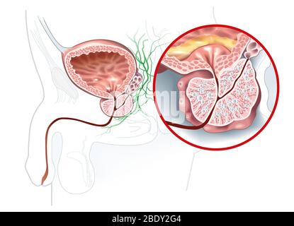 Abbildung zeigt gesunde Prostata und gutartige Prostatahyperplasie (BPH), vergrößerte Prostata mit Blase, Harnröhre und Samenbläschen Stockfoto