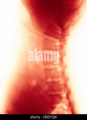 Kompression in Lendenwirbeln Stockfoto