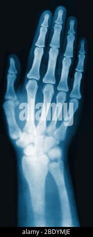 Röntgenbild der Hand der Frau, 1896 Stockfoto