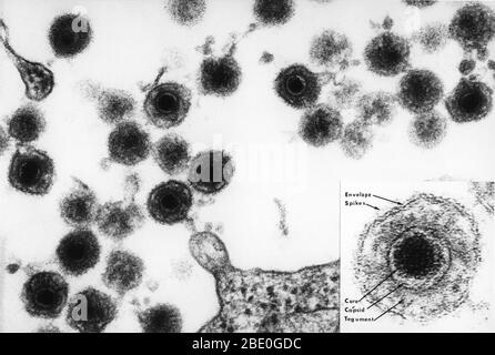 Das Foto eines Elektronenmikrographen von HHV-6 enthält auch einen markierten Einsatz des reifen Virus-Teilchens. Das HHV-6 ist ein doppelsträngiger DNA-Virus aus der Herpesfamilie. Die hier gezeigten Viruspartikel sind gereift und werden dann aus der angefallenen Lymphozyte freigesetzt. Das 'Eulenauge' der Viruspartikel ist charakteristisch für die Herpesfamilie. Das HHV-6 oder das menschliche Herpesvirus-6 wurde angenommen, dass es B-Zellen infizieren sollte und wurde zu einer Zeit als HBLV, menschliches b-lymphotropes Virus, bezeichnet. Es ist jetzt bekannt, T-Zellen zu infizieren und ist die Ursache für die Kindheit Ausschlag 'Roseola' und einige Fälle o Stockfoto