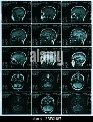 Ein Blatt mit MRT-Scans, die die normale Anatomie des Gehirns zeigen. Auffällig sind die Großhirnrinde, der Corpus callosum, der Thalamus, die Medulla oblongata, das Kleinhirn und der Hirnstamm. Stockfoto