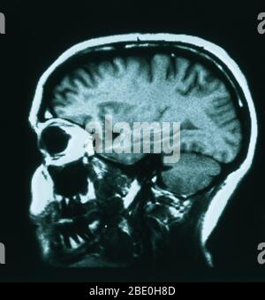 Sagittale (von der Seite) T1-gewichtete MRT zeigt normale Anatomie des Gehirns einschließlich: Die Großhirnrinde, Corpus callosum, Thalamus, Medulla oblongata, Kleinhirn und Hirnstamm. Stockfoto