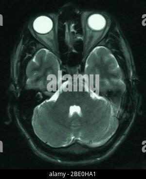 MRT des Gehirns (axiale Ansicht) eines 26-jährigen Mannes. Die MRT wurde als Folge einer Kopfverletzung bei einem Autounfall aufgenommen. Die Diagnose der MRT-Untersuchungen ist eine kleine Arachnoidzyste im parasagittalen vorderen linken frontalen Bereich. Die Zyste ist in dieser Ansicht nicht zu sehen, da sie unterhalb der betroffenen Region liegt. Alle anderen Aspekte erscheinen normal. Stockfoto