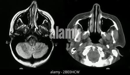 MRT, die das normale Gehirn und die Nebenhöhlen zeigen. Stockfoto