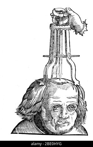 Entfernen des Knochens mit einer Trochlea bipes, nach Trephination, 1527. Trepanning ist eine chirurgische Intervention, bei der ein Loch gebohrt oder in den menschlichen Schädel geschabt wird, wobei die Dura mater ausgesetzt wird, um Gesundheitsprobleme im Zusammenhang mit intrakraniellen Erkrankungen zu behandeln. Höhlenmalereien deuten darauf hin, dass die Menschen glaubten, dass die Praxis epileptische Anfälle, Migräne, psychische Störungen heilen würde und der Knochen, der trepanned wurde, wurde als Charme gehalten, um böse Geister fern zu halten. Trepanation wurde auch in der klassischen und Renaissance-Perioden praktiziert. Stockfoto