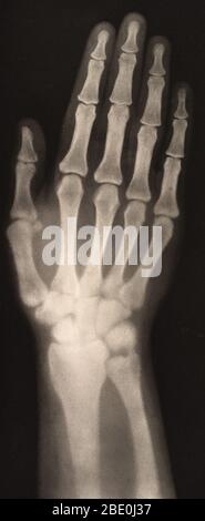 Historische Röntgenaufnahme einer Frauenhand, 1896. Aufgenommen von Josef Maria Eder (Österreicher, 1855-1944) und Eduard Valenta (Österreicher, 1857-1937). Tiefdruck. Eder war Direktor eines Instituts für grafische Prozesse und Autor einer frühen Geschichte der Fotografie. Mit dem Fotochemiker Valenta produzierte er im Januar 1896, weniger als einen Monat nachdem Wilhelm Conrad Rontgen seine Entdeckung der Röntgenstrahlung veröffentlicht hatte, ein Portfolio. Eder und Valenta's Volumen, aus dem diese Platte stammt, demonstrierten die magische Fähigkeit des Röntgenstrahls, die verborgene Struktur lebender Dinge zu offenbaren. Menschliche Hände und Füße, Fische, Frösche, ein Schnabel Stockfoto
