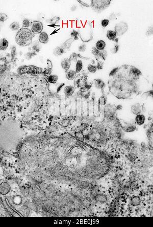 Das humane T-Zell-Leukämie-Virus Typ 1 (HTLV-1), (auch bekannt als das humane T lymphotrope Virus Typ 1), das humane T-Zell-Leukämie-Virus Typ 1 (HTLV-1), ein humanes Onkoretrovirus, ist der ätiologische Wirkstoff der erwachsenen T-Zell-Leukämie und der tropischen spastischen Paraparese/HTLV-1-assoziierten Myelopathie. Stockfoto