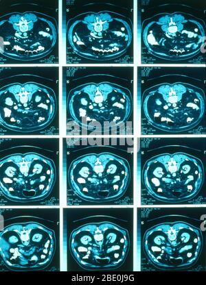 Normale CT-Scans des Abdomens. Stockfoto
