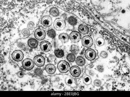 Negativ gefärbte Transmission Electron Micrograph (TEM) zeigt das Vorhandensein von zahlreichen Herpes simplex Virionen im Kern in dieser Gewebeprobe. Genitalherpes ist eine genitale Infektion durch das Herpes simplex Virus (HSV) verursacht. Die meisten Menschen, die Herpes tragen, sind sich nicht bewusst, dass sie infiziert wurden und viele werden nie einen Ausbruch erleiden, der Blasen ähnlich wie bei Fieberbläschen beinhaltet. Zwar gibt es keine Heilung für Herpes, im Laufe der Zeit Symptome sind immer milder und Ausbrüche sind immer häufiger. Die typische Manifestation einer primären Infektion sind Cluster von Genitalbläschen consi Stockfoto