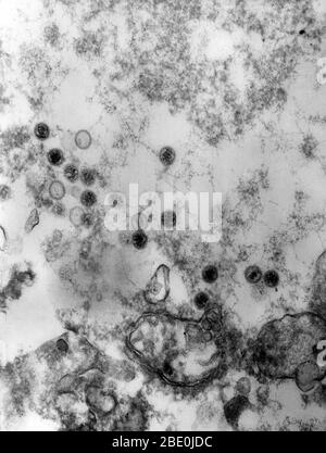 Transmission Electron Micrograph (TEM), der das Vorhandensein zahlreicher Epstein-Barr-Viren (EBV)-Virionen aufdeckt. Das Epstein-Barr-Virus (EBV), auch Human Herpesvirus 4 (HHV-4) genannt, ist einer von acht bekannten humanen Herpesvirus-Typen in der Herpesfamilie und einer der häufigsten Viren beim Menschen, bekannt als Ursache für infektiöse Mononukleose (Drüsenfieber). Es ist auch mit bestimmten Formen von Krebs, wie Hodgkin-Lymphom, Burkitt-Lymphom, Magenkrebs, Nasopharyngealkarzinom und Bedingungen im Zusammenhang mit humanem Immundefizienz-Virus (HIV), wie Hairy le assoziiert Stockfoto