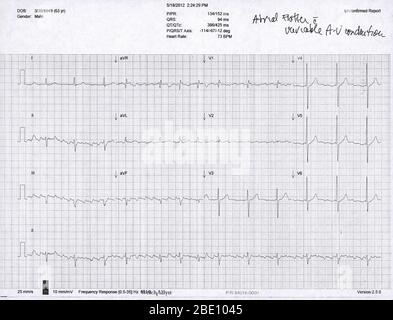 Elektrokardiogramm (EKG) eines 63-jährigen Mannes mit Vorhofflattern und AV-Leitung. Ein EKG misst das Pumpen der Herzkammern mit 12 externen Elektroden (I-III, V1-V6 und AVR, aVL und aVF) und zeichnet es als elektrische Wellen auf. Ein Flattern ist eine erhöhte Kontraktionsrate der oberen Herzkammern (Atrien), die als zahlreiche flache Wellen gesehen wird Stockfoto