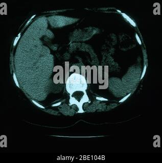 Ein axiales (querschnittes) CT-Bild durch die Lunge eines 53-jährigen Weibchens. Der Scan zeigt die Tortuosität und die Prominenz der Gefäßversorgung im rechten Mediastinum Superior. Ebenfalls vorhanden sind verkalkte linke Hilarnodulen und multiple punktuäre Verkalkungen in der Milz, die mit Granulom konsistent sind. Stockfoto