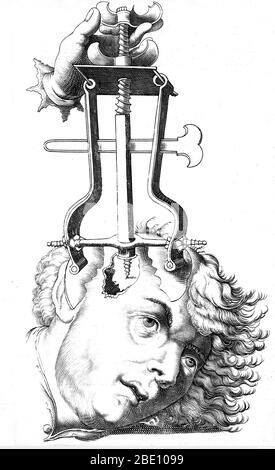 Entfernen des Knochens mit einer Trochlea bipes, nach Trephination, 16. Jahrhundert. Succenturiatus anatomicus. Petrus Paaw. Veröffentlicht: 1616, basierend auf Bild aus dem 1500er. Trepanning ist eine chirurgische Intervention, bei der ein Loch gebohrt oder in den menschlichen Schädel geschabt wird, wobei die Dura mater ausgesetzt wird, um Gesundheitsprobleme im Zusammenhang mit intrakraniellen Erkrankungen zu behandeln. Höhlenmalereien deuten darauf hin, dass die Menschen glaubten, dass die Praxis epileptische Anfälle, Migräne, psychische Störungen heilen würde und der Knochen, der trepanned wurde, wurde als Charme gehalten, um böse Geister fern zu halten. Trepanation wurde auch in der klassischen und Renaissance praktiziert Stockfoto