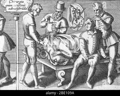 Trepanning wird durchgeführt, 1594. Ein Patient liegt still, während Trepaning auf seinem Schädel durchgeführt wird. Ein anderer ängstlich aussehender Mann sitzt neben ihm und ist bereit, sich der gleichen Operation zu unterziehen. Trepanning ist eine chirurgische Intervention, bei der ein Loch gebohrt oder in den menschlichen Schädel geschabt wird, wobei die Dura mater ausgesetzt wird, um Gesundheitsprobleme im Zusammenhang mit intrakraniellen Erkrankungen zu behandeln. Höhlenmalereien deuten darauf hin, dass die Menschen glaubten, dass die Praxis epileptische Anfälle, Migräne, psychische Störungen heilen würde und der Knochen, der trepanned wurde, wurde als Charme gehalten, um böse Geister fern zu halten. Trepanation wurde auch praktiziert Stockfoto