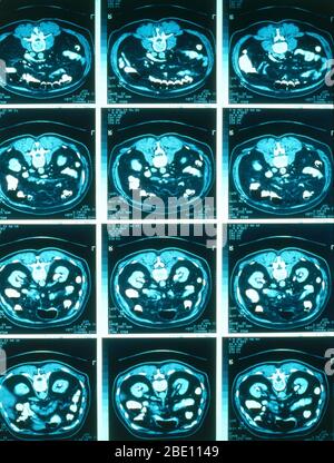 Normale CT-Scans des Abdomens. Stockfoto