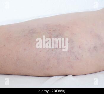 Krampfadern an den Beinen einer Person, Thrombophlebitis Stockfoto