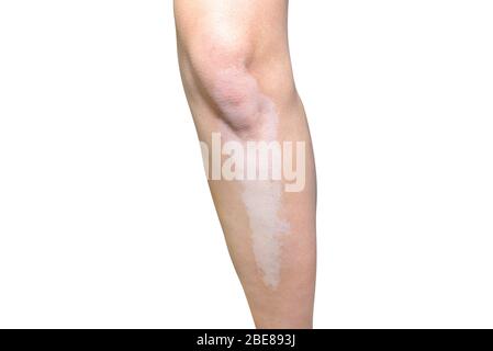 Flecken von Vitiligo-Krankheit auf einem Bein in einer jungen kaukasischen Frau, auf einem weißen Hintergrund mit einem Schnittpfad isoliert. Stockfoto