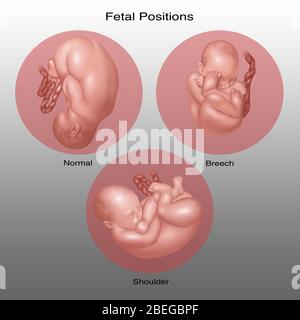 Fetus-Positionen in der Gebärmutter, Illustration Stockfoto