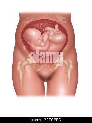 Fetus in Schulterposition, Abbildung Stockfoto