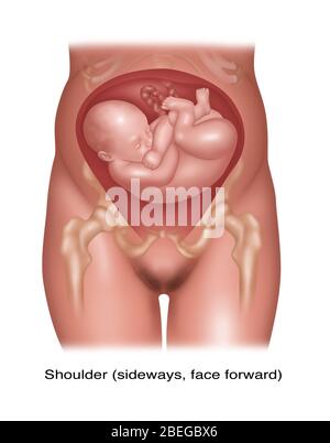 Fetus in Schulterposition, Abbildung Stockfoto