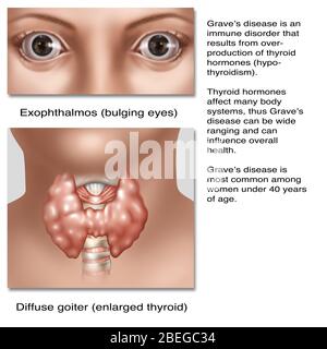 Graves Krankheit ist eine Immunstörung, die durch Überproduktion von Schilddrüsenhormonen (Hyperthyreose) resultiert. Schilddrüsenhormone beeinflussen viele Körpersysteme, so Graves Krankheit kann weit reichend sein und kann die allgemeine Gesundheit beeinflussen. Diese Abbildung zeigt zwei häufige Symptome der Krankheit, Exophthalmos oder prall Augen und eine vergrößerte Schilddrüse (Kropf). Gräberkrankheit ist am häufigsten bei Frauen unter 40 Jahren. Stockfoto