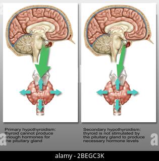 Primäre Und Sekundäre Hypothyreose, Abbildung Stockfoto