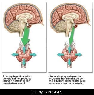Primäre Und Sekundäre Hypothyreose, Abbildung Stockfoto