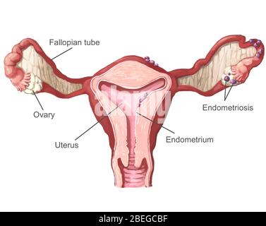 Endometriose, Illustration, Beschriftet Stockfoto