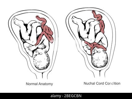 Nacktschnur und Geburt Asphyxia, Illustration Stockfoto