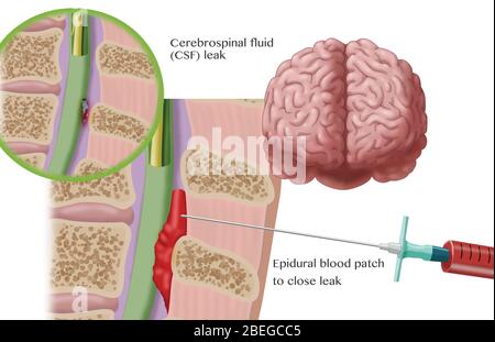 Epidurale Blutpflaster Verfahren, Illustration Stockfoto