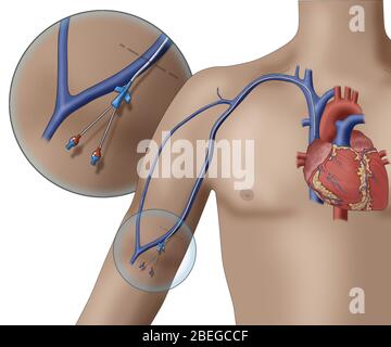 PICC intravenöses Gerät, Illustration Stockfoto