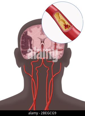 Ischämischer Schlaganfall, Illustration Stockfoto