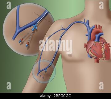 PICC intravenöses Gerät, Illustration Stockfoto