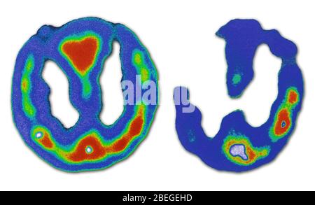 Hirnscans (normal und Alzheimer) Stockfoto