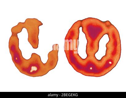 Hirnscans (normal und Alzheimer) Stockfoto