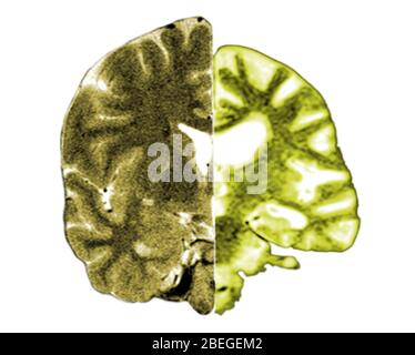 Normale und Alzheimer-Gehirn-MRI Stockfoto