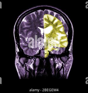 Normale und Alzheimer-Gehirn-MRI Stockfoto