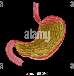 Abbildung des sauren Reflux Stockfoto