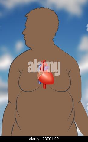 Adipositas erhöht das Risiko von Herzerkrankungen Stockfoto
