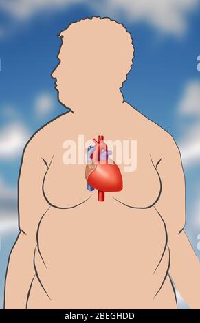 Adipositas erhöht das Risiko von Herzerkrankungen Stockfoto