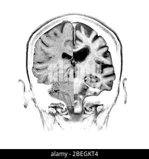 Normal / Alzheimer Gehirn Vergleich Stockfoto
