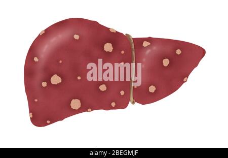 Leberzirrhose Im Stadium 2 Stockfoto