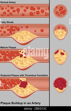 Plaque in der Arterie Stockfoto
