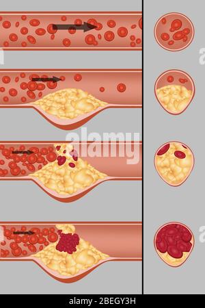 Plaque in der Arterie Stockfoto